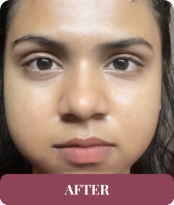 After treatment